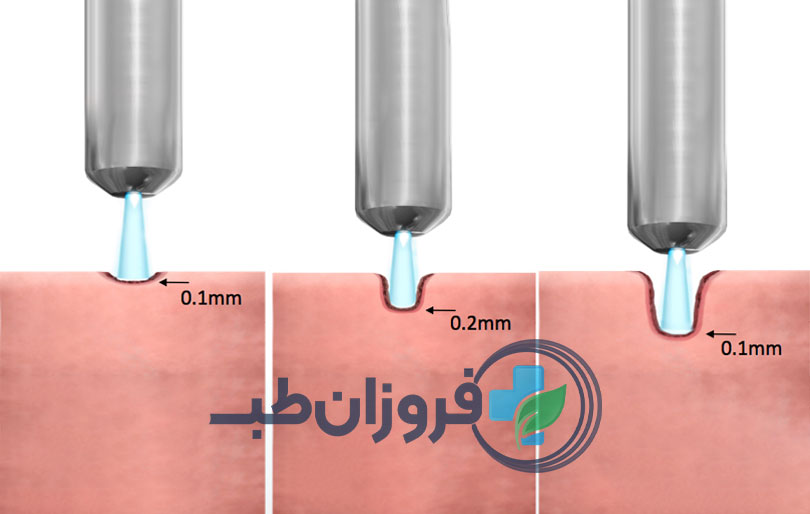 پلاسما درمانی جدیدترین نوع درمان زخم