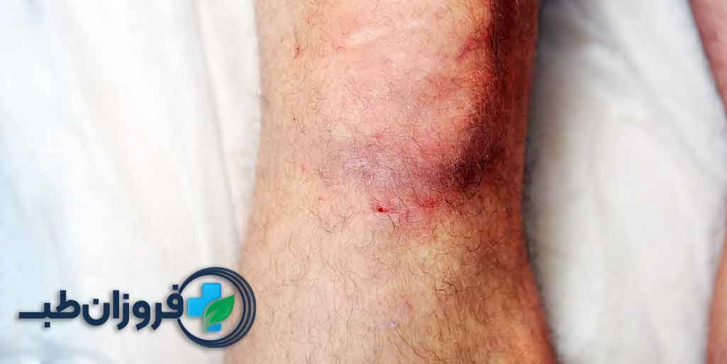 کربوکسی تراپی زخم