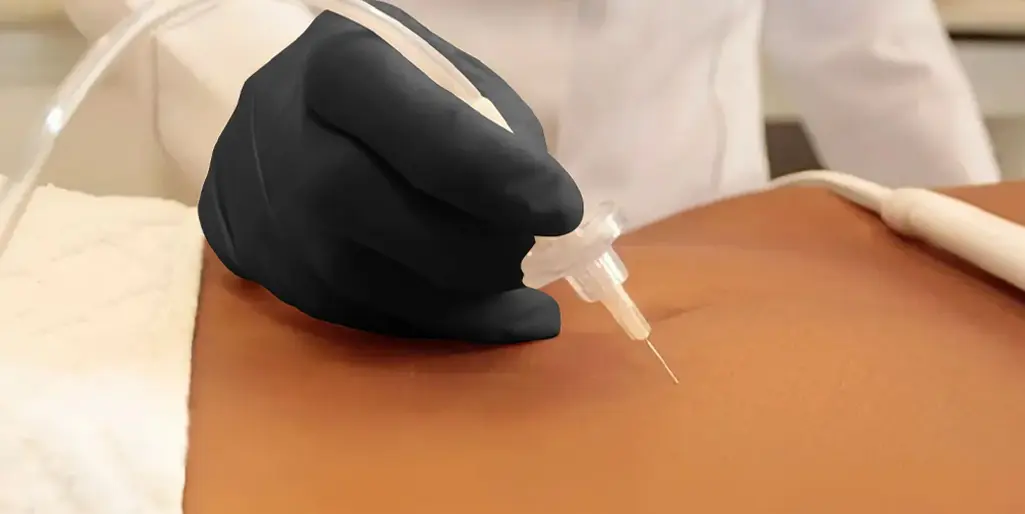 کربوکسی تراپی و درمان زخمهای مزمن